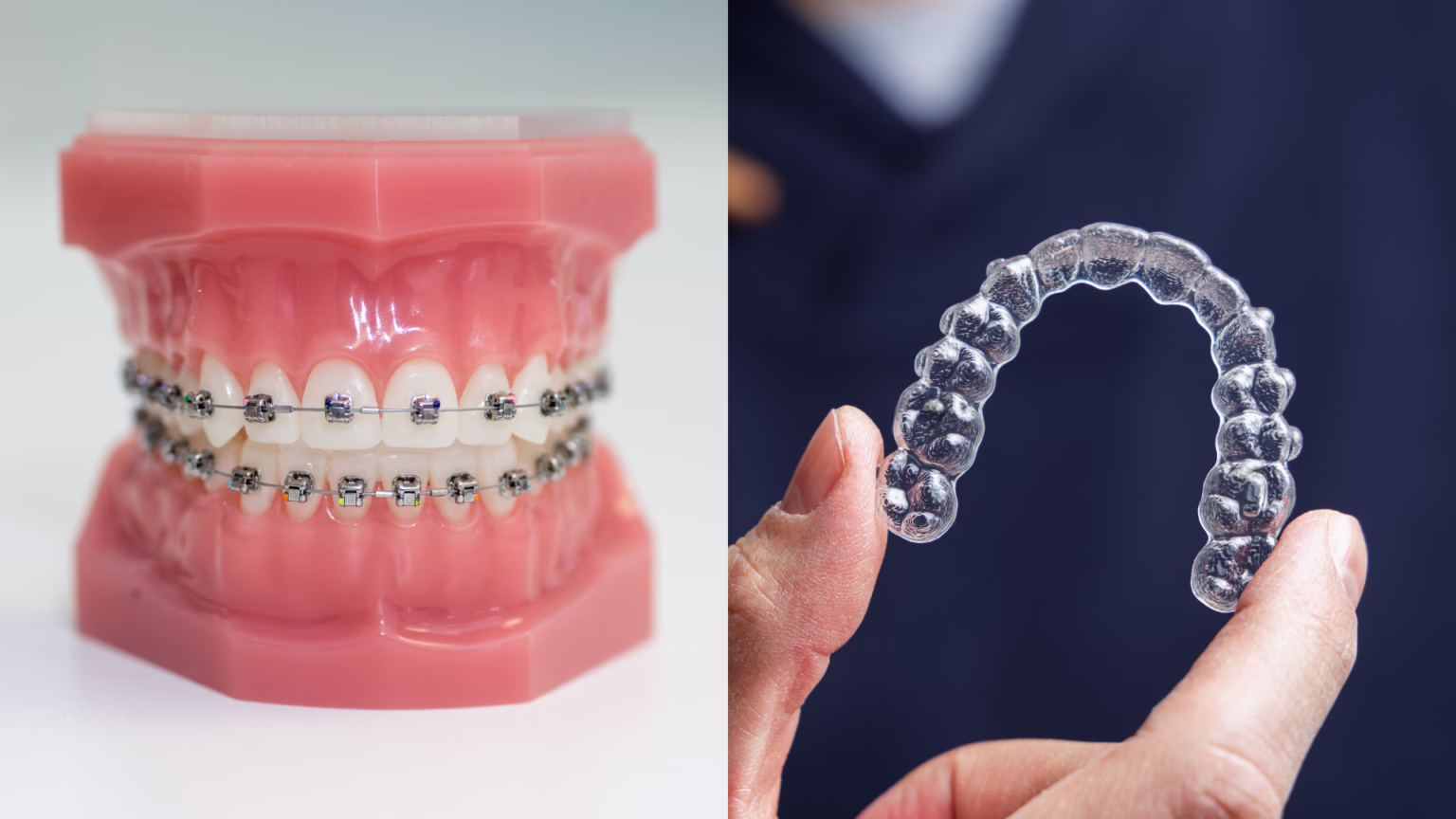 Braces vs. Clear Aligners: What’s Right for You?