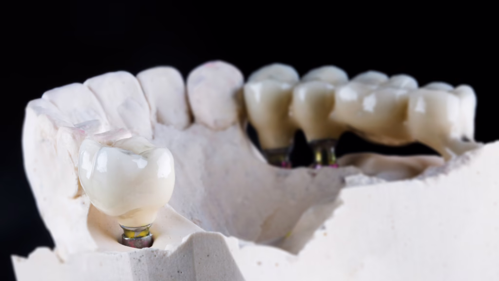 Dental Implants in Scottsdale | What If You Have Gum Disease?