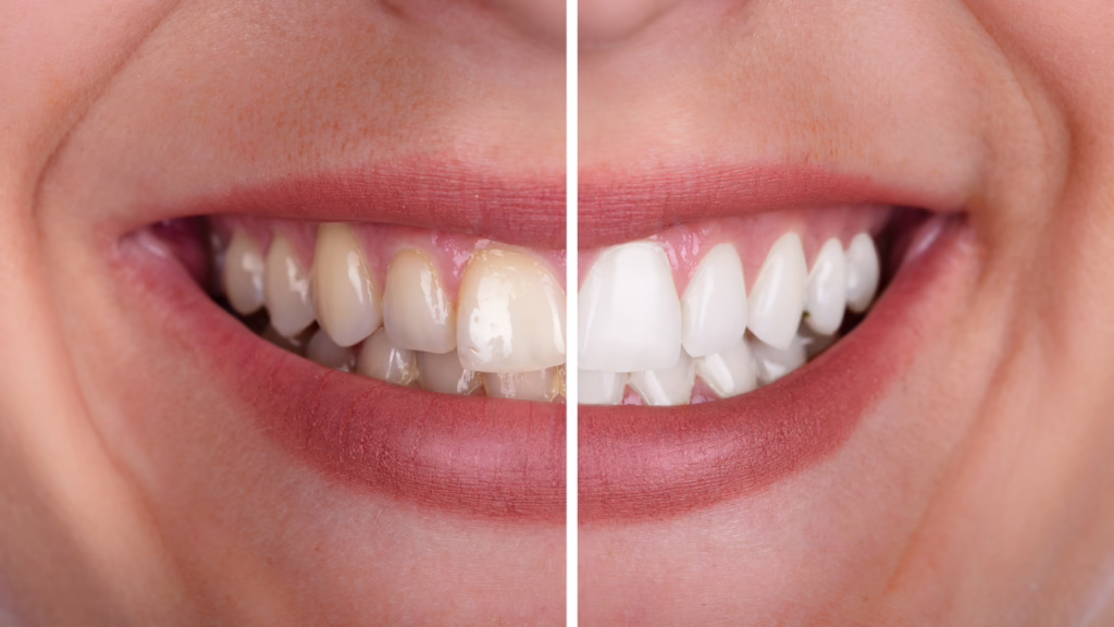 When Should You See a Dentist for Yellow Teeth?